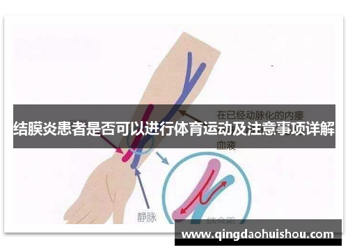结膜炎患者是否可以进行体育运动及注意事项详解